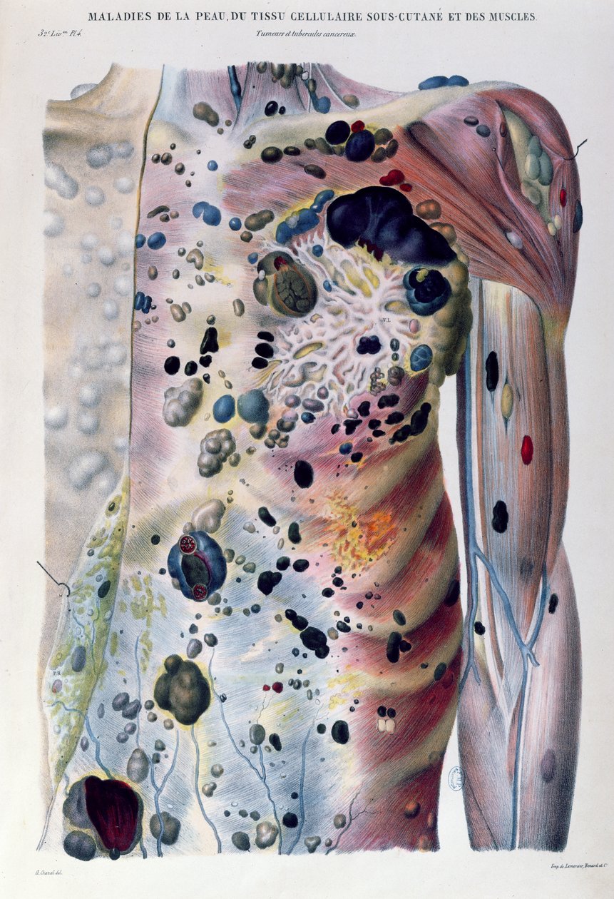 Tumeurs et tubercules cancéreux, de 