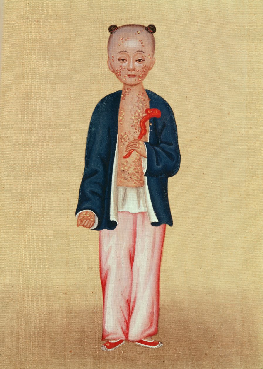 Enfant avec la variole - Chinese School