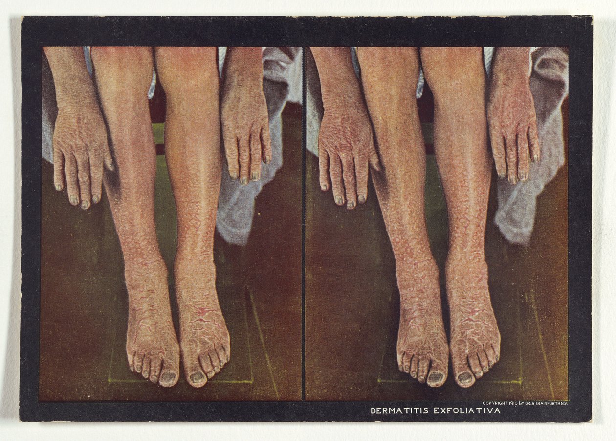 Dermatite exfoliante - Dr. Selden I. Rainforth