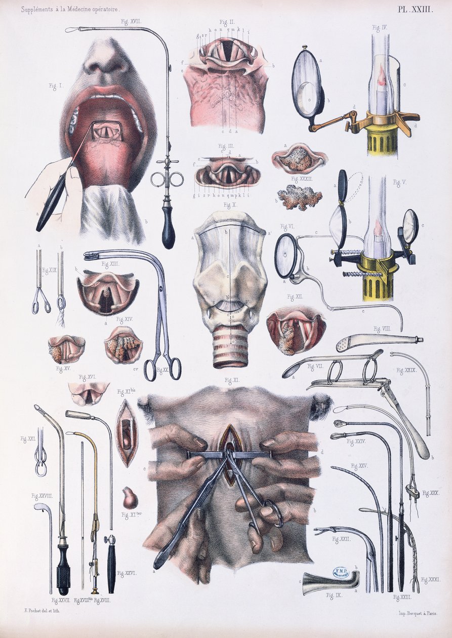 Opération de trachéotomie, planche de 