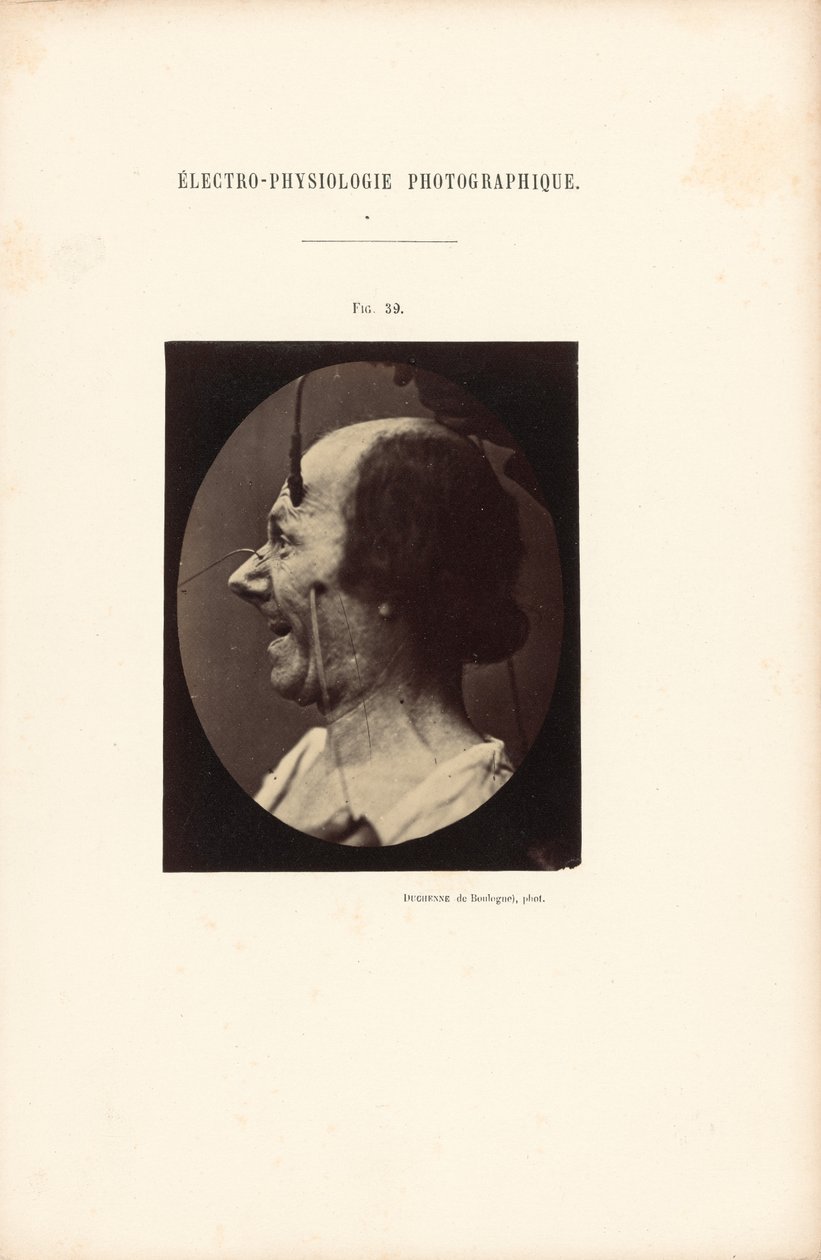 Électro-Physiologie Photographique, Figure 39 - Guillaume Benjamin Duchenne