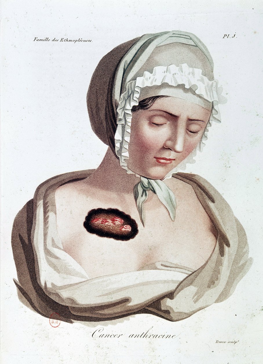 Cancer anthracine - Alibert, B.N. - Jean Louis Alibert