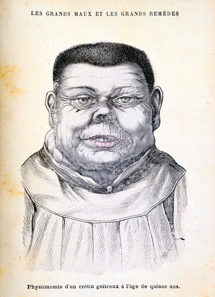 Crétin âgé de 15 ans, vers 1890 - Unbekannt