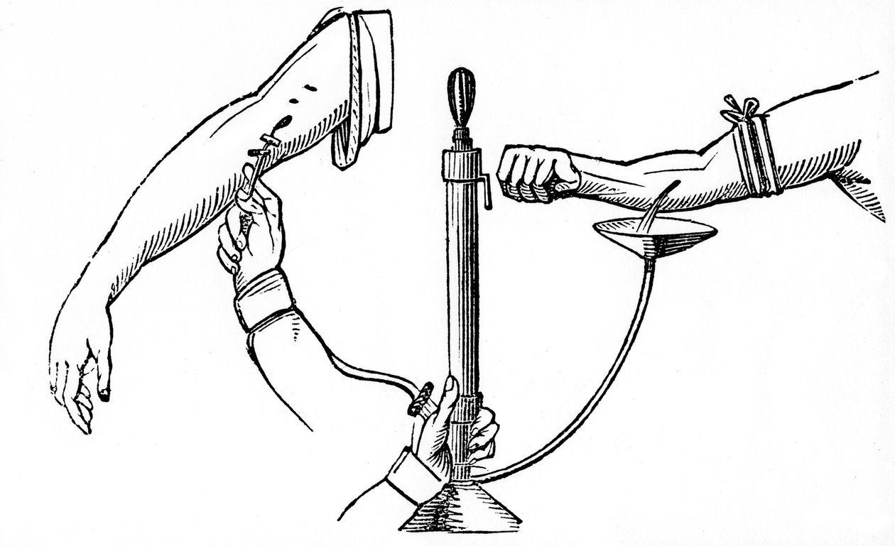 Transfusion sanguine de personne à personne, 1833 - Unbekannt