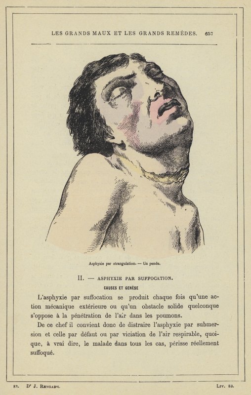 Asphyxie par strangulation, Un pendu - French School