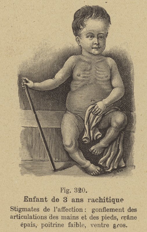 Enfant de trois ans souffrant de rachitisme - German School